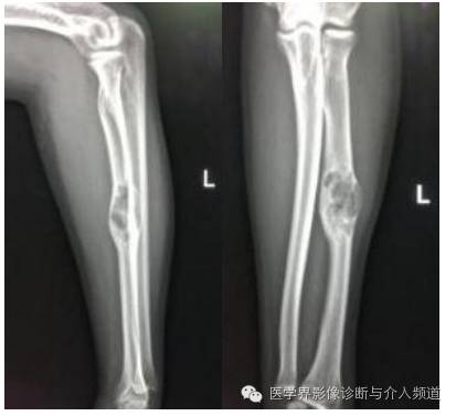 【病例】桡骨动脉瘤样骨囊肿1例X线及MR影像表现