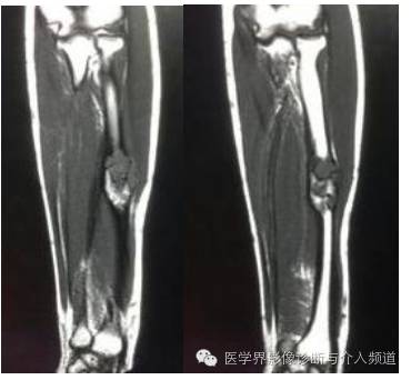 【病例】桡骨动脉瘤样骨囊肿1例X线及MR影像表现