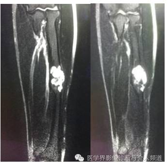 【病例】桡骨动脉瘤样骨囊肿1例X线及MR影像表现