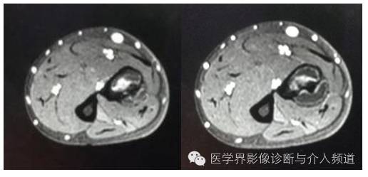 【病例】桡骨动脉瘤样骨囊肿1例X线及MR影像表现