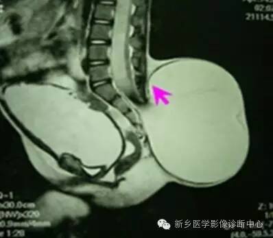 脊柱裂——隐性脊柱裂、脊膜膨出、脊髓脊膜膨出