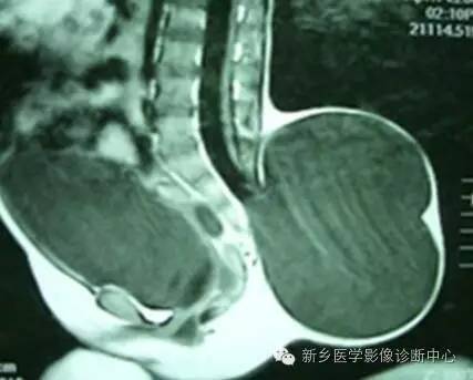 脊柱裂——隐性脊柱裂、脊膜膨出、脊髓脊膜膨出