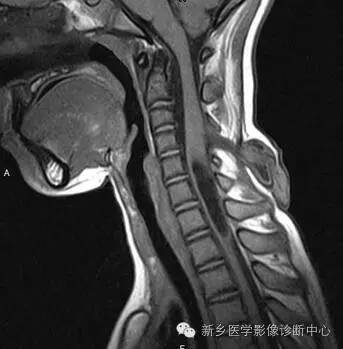 脊柱裂——隐性脊柱裂、脊膜膨出、脊髓脊膜膨出