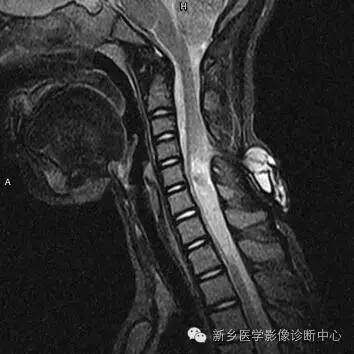 脊柱裂——隐性脊柱裂、脊膜膨出、脊髓脊膜膨出