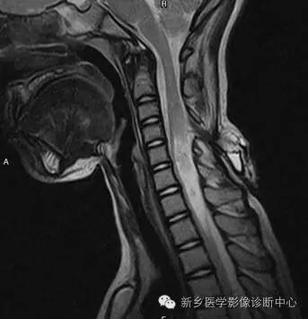 脊柱裂——隐性脊柱裂、脊膜膨出、脊髓脊膜膨出