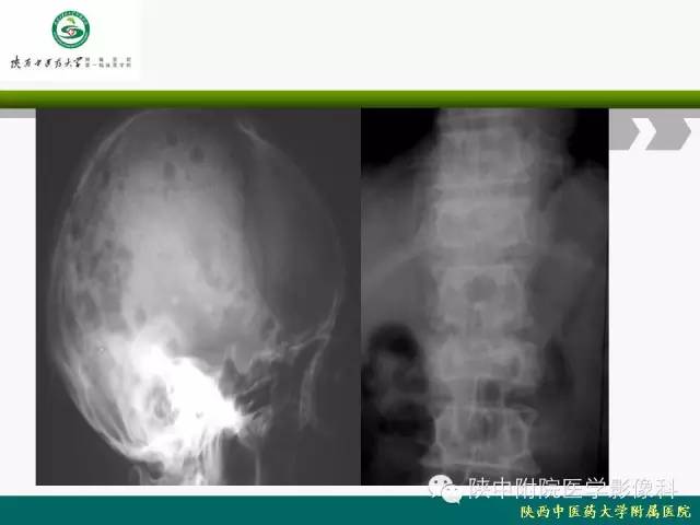 【PPT】脊柱肿瘤的影像学诊断
