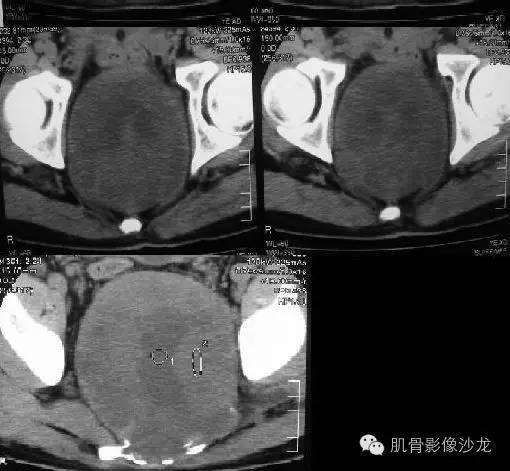 【病例】骶骨神经纤维瘤一例CT影像表现