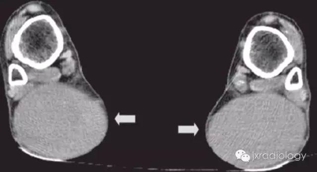 跟腱黄色瘤 Achilles tendon xanthoma
