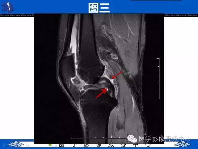 【影像征象】双后交叉韧带征