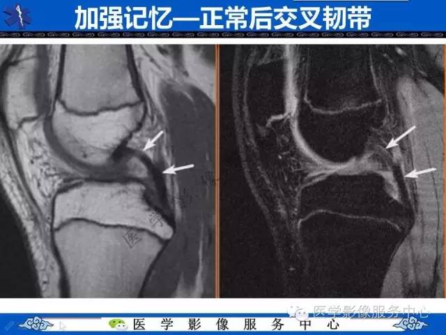 【影像征象】双后交叉韧带征