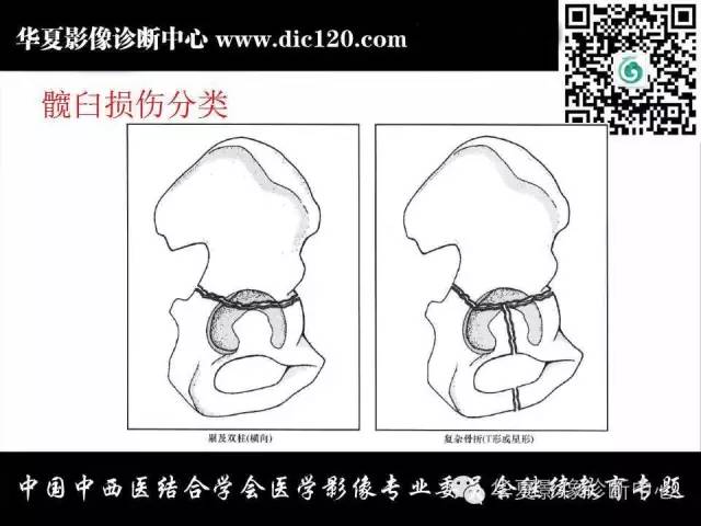 【PPT】髋关节常见疾病影像学诊断
