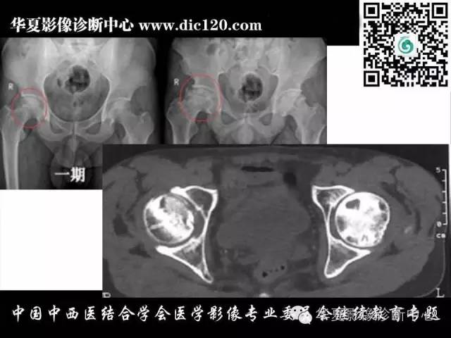 【PPT】髋关节常见疾病影像学诊断