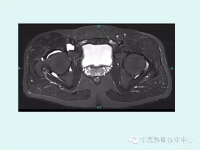【PPT】大转子周围滑囊炎
