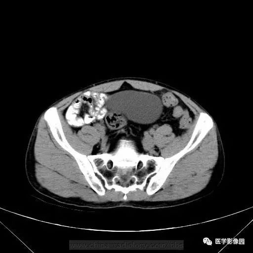 【病例】骶前支气管源性囊肿1例CT