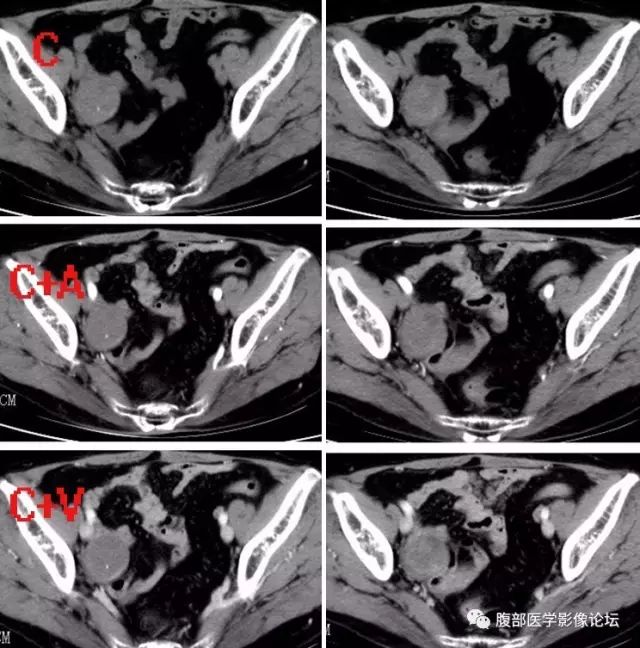 【病例】右侧卵巢甲状腺肿伴囊性变1例CT