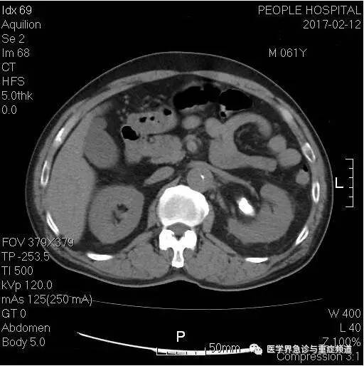 【病例】差点漏诊主动脉夹层，幸亏多看了眼CT