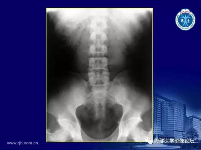 【PPT】急腹症