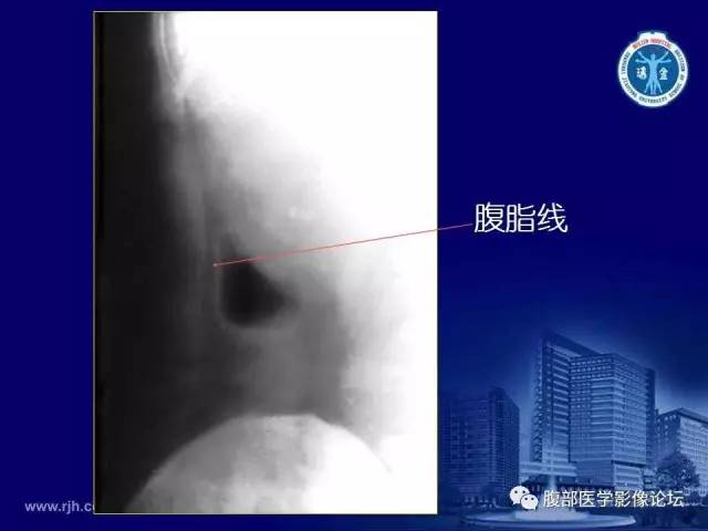 【PPT】急腹症