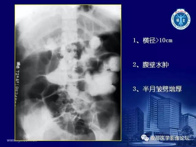 【PPT】急腹症