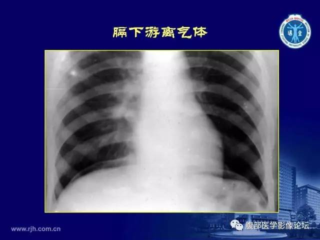 【PPT】急腹症