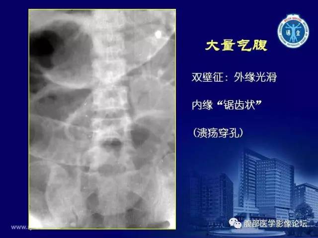 【PPT】急腹症
