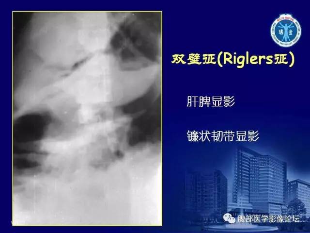 【PPT】急腹症