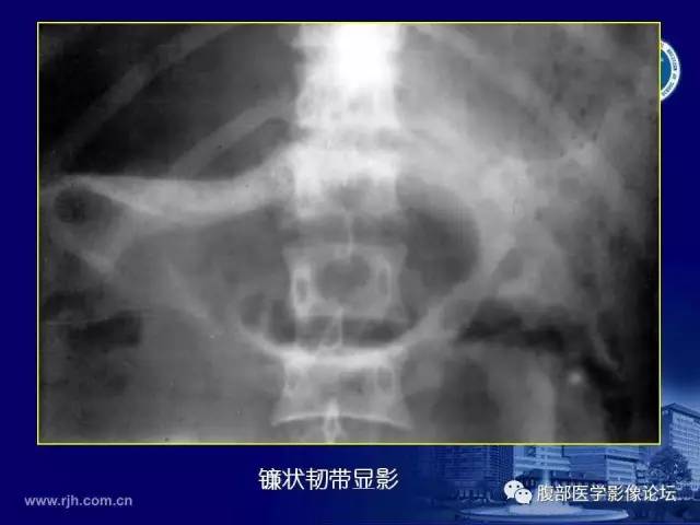 【PPT】急腹症