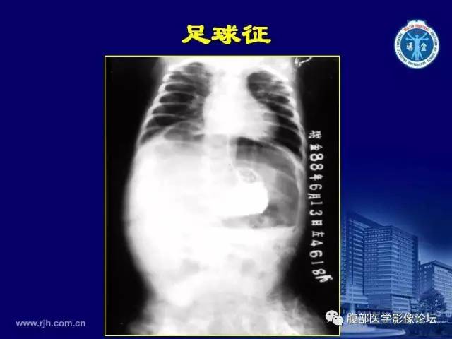 【PPT】急腹症