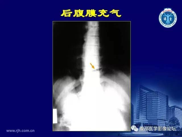 【PPT】急腹症
