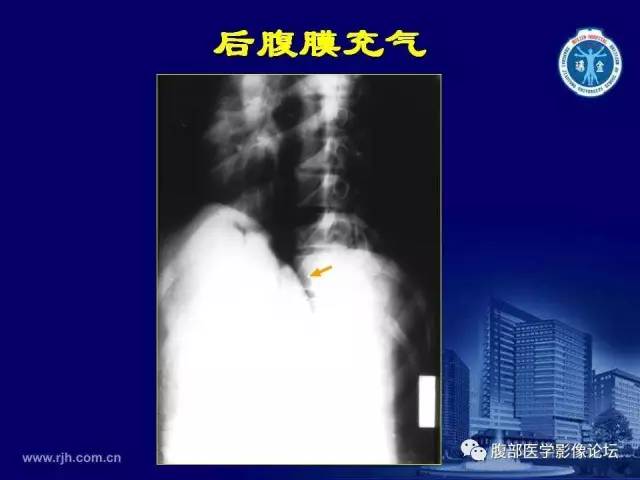 【PPT】急腹症