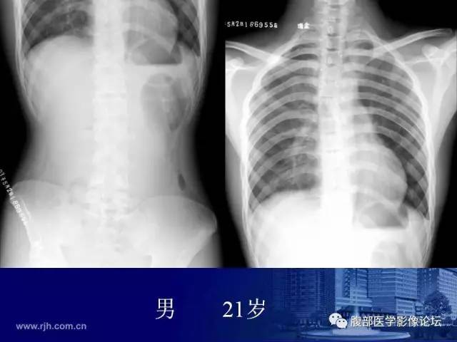 【PPT】急腹症