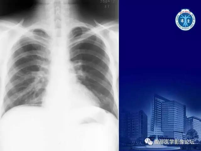 【PPT】急腹症