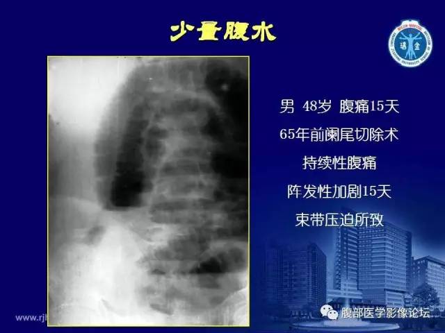 【PPT】急腹症