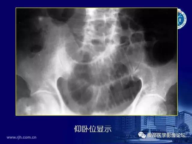 【PPT】急腹症