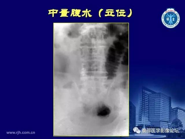 【PPT】急腹症