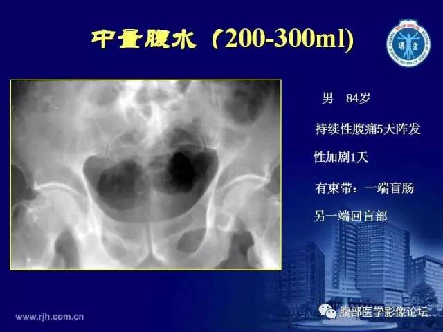 【PPT】急腹症