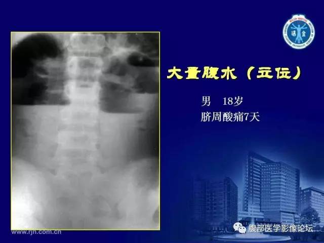 【PPT】急腹症