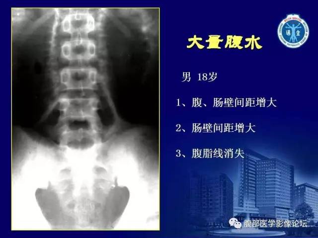【PPT】急腹症