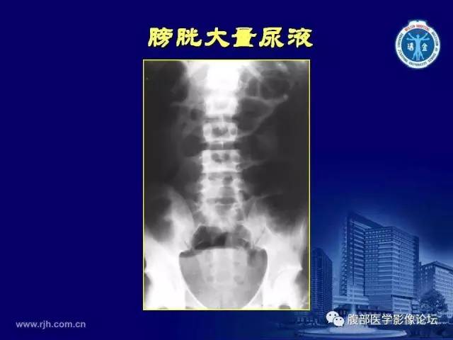 【PPT】急腹症