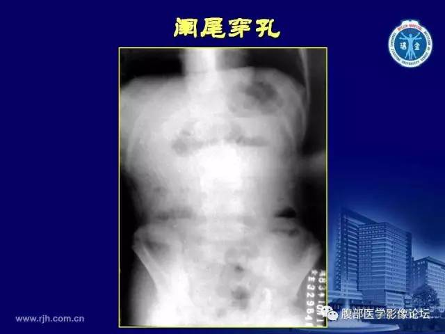 【PPT】急腹症