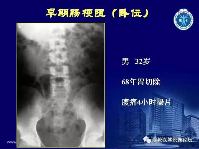 【PPT】急腹症