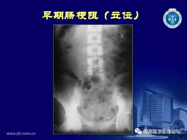 【PPT】急腹症