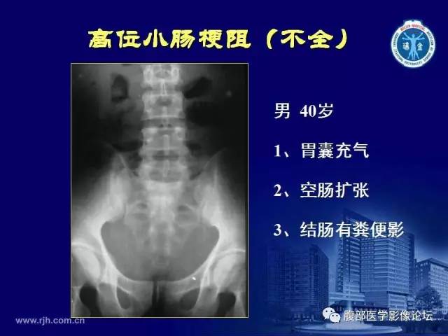 【PPT】急腹症