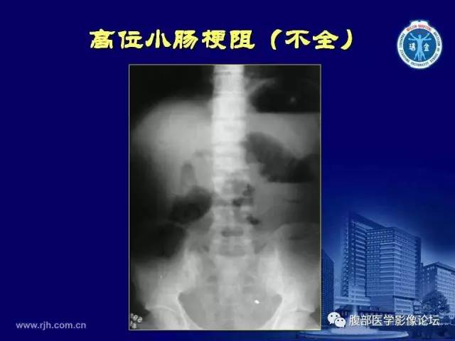 【PPT】急腹症