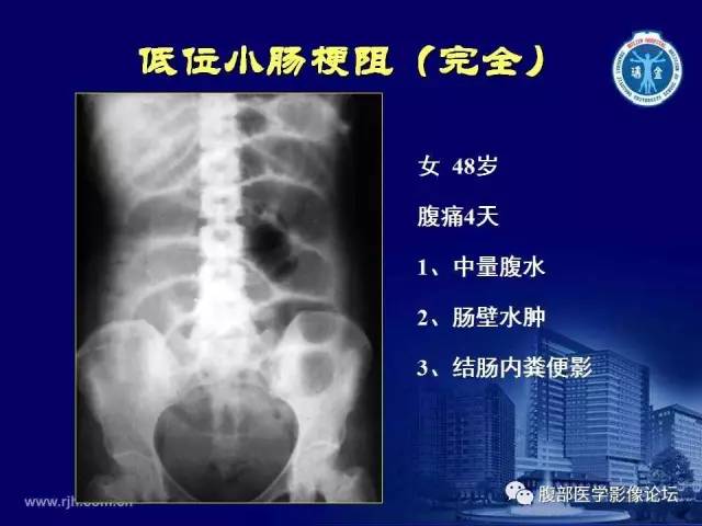 【PPT】急腹症