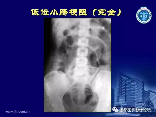 【PPT】急腹症