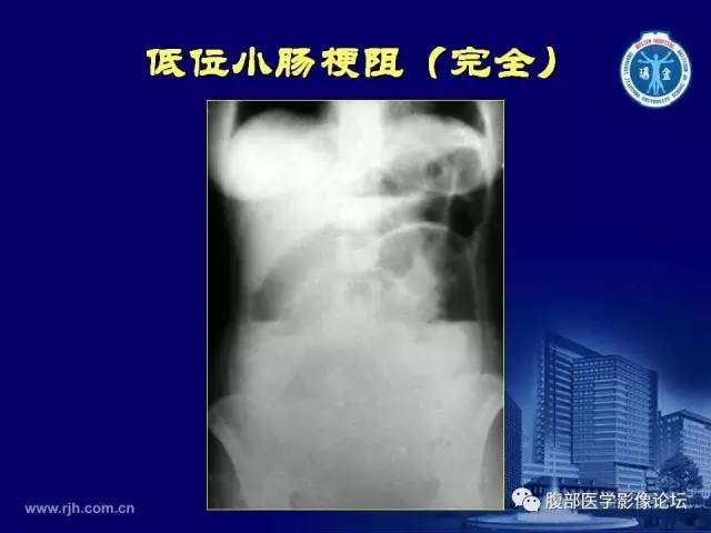 【PPT】急腹症