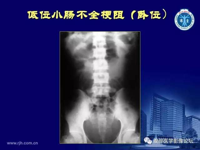 【PPT】急腹症