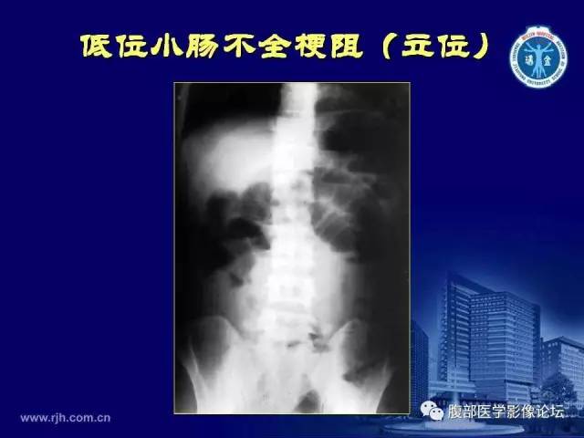 【PPT】急腹症