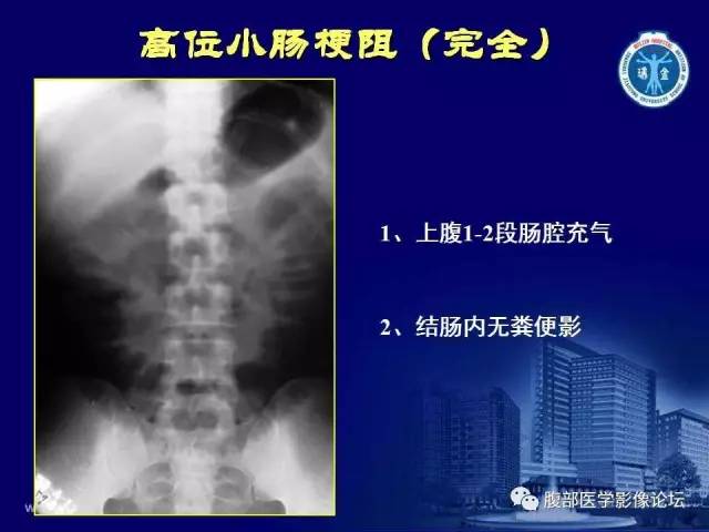 【PPT】急腹症